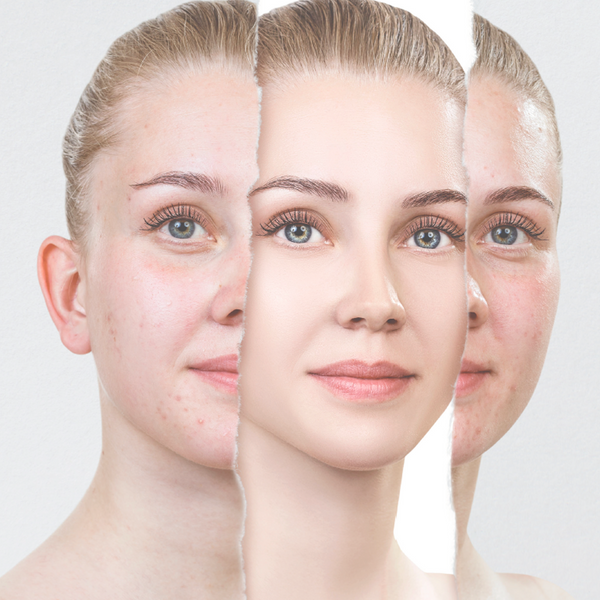 BLEMISH PRONE RESCUE REPAIR, SOOTHE & PREVENT SERUM CONCENTRATE